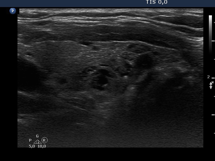 Right lobe, longitudinal scan