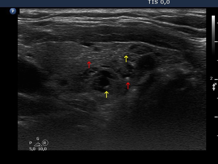 Right lobe, longitudinal scan