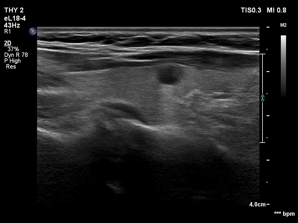 Right lobe, longitudinal scan