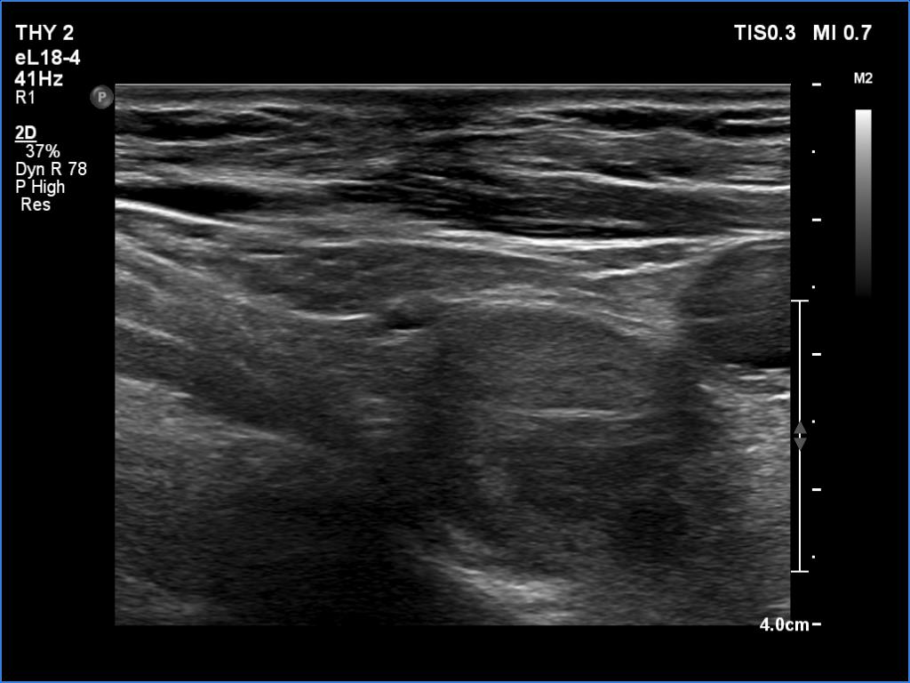 Right lobe, longitudinal scan