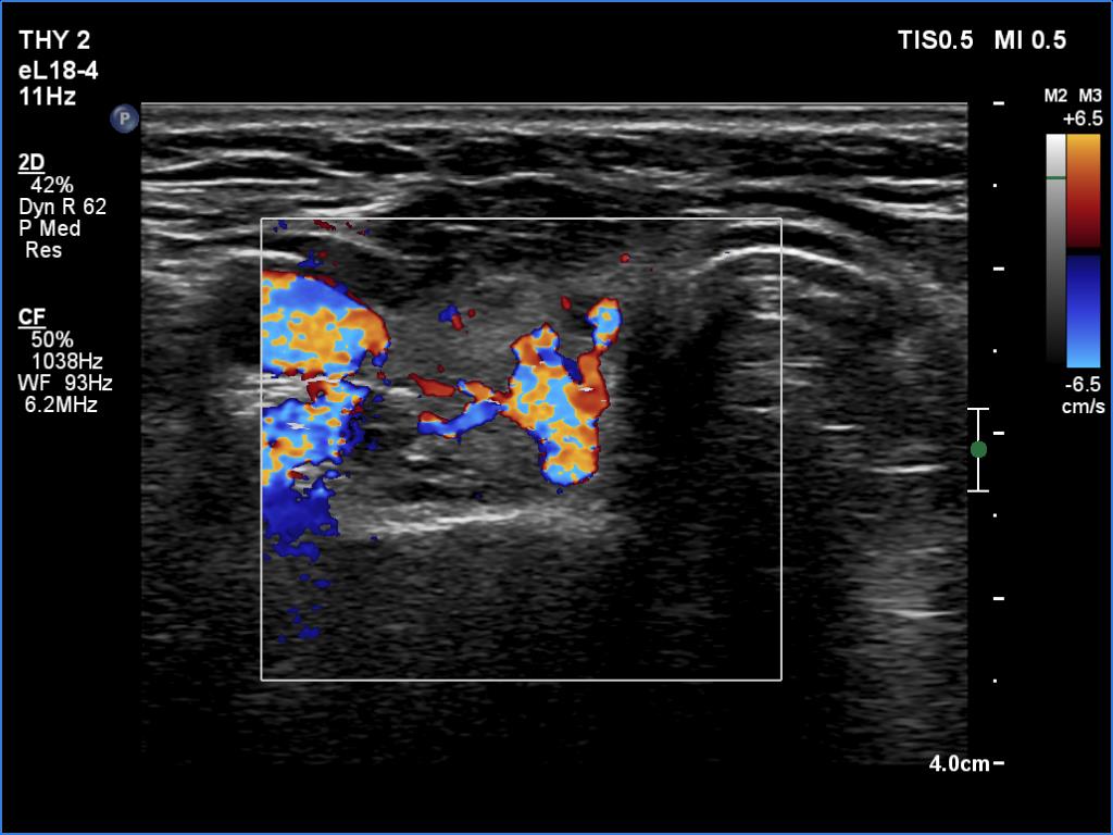 Right lobe, longitudinal scan