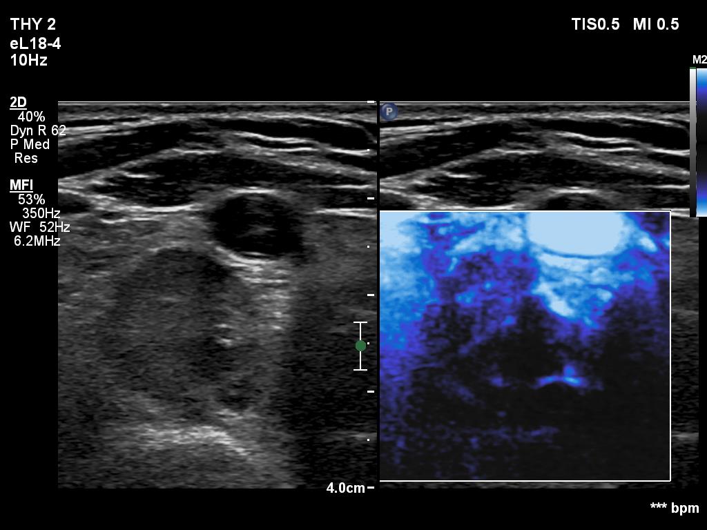 Right lobe, longitudinal scan