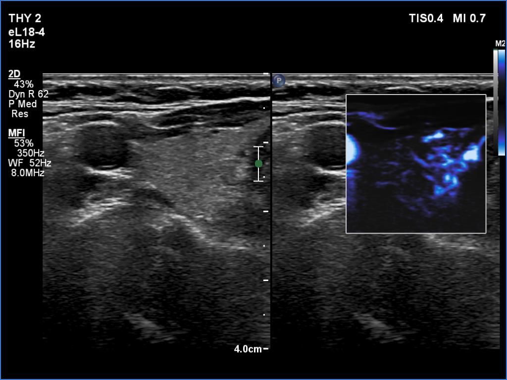 Right lobe, longitudinal scan