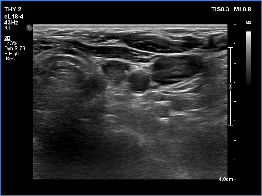 Right lobe, longitudinal scan