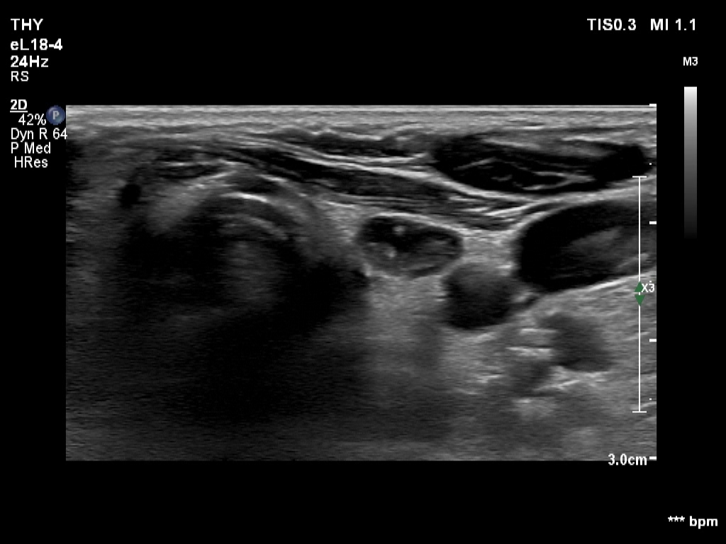 Right lobe, longitudinal scan