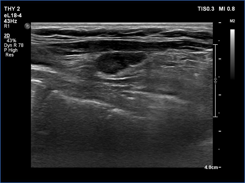 Right lobe, longitudinal scan