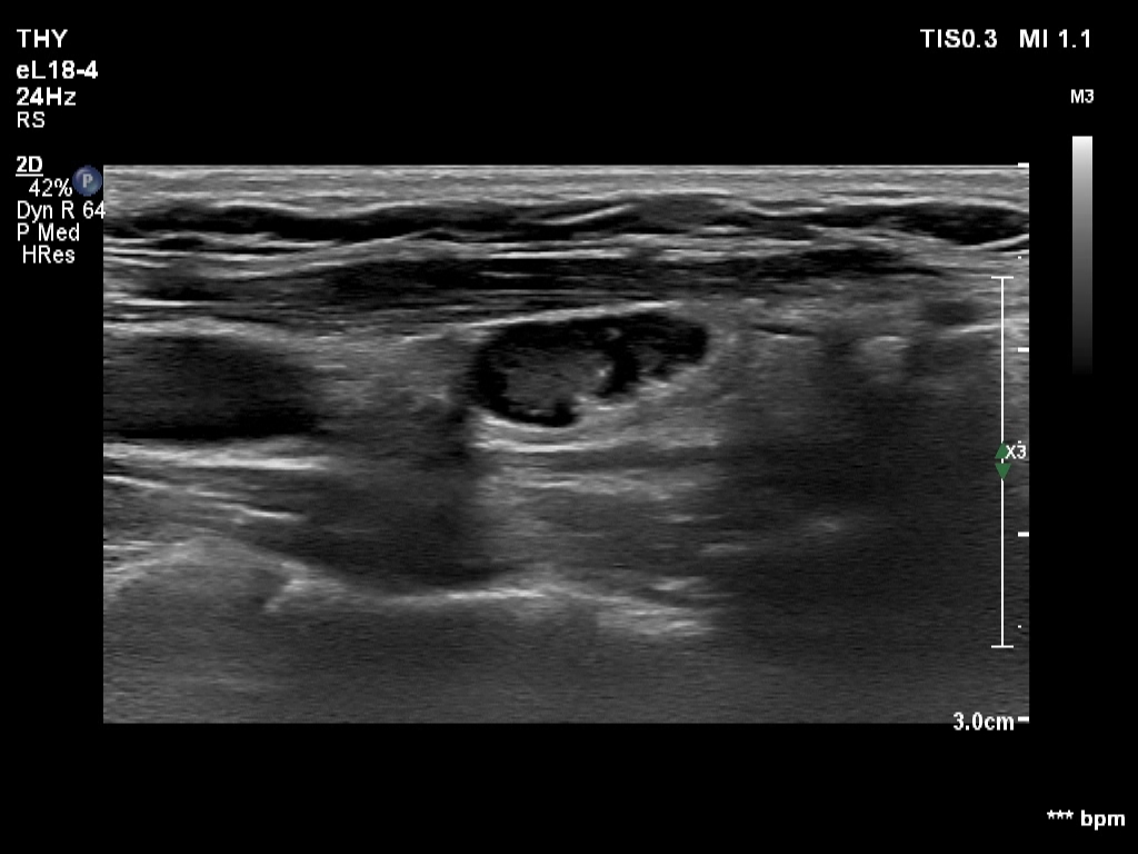 Right lobe, longitudinal scan