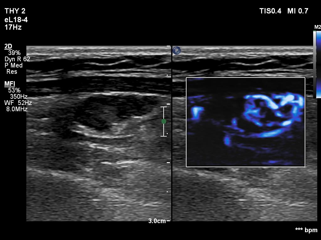 Right lobe, longitudinal scan