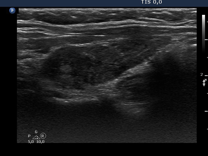 Right lobe, longitudinal scan
