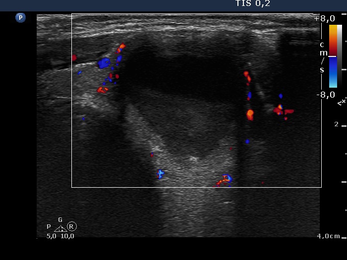 Right lobe, longitudinal scan