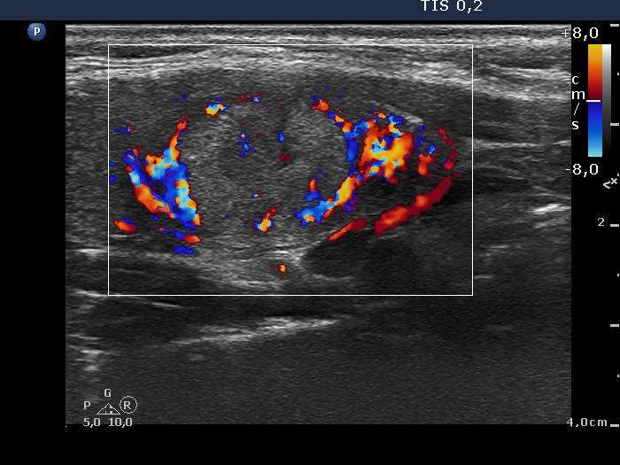Right lobe, longitudinal scan