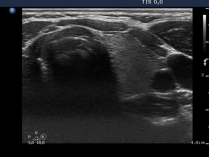 Right lobe, longitudinal scan