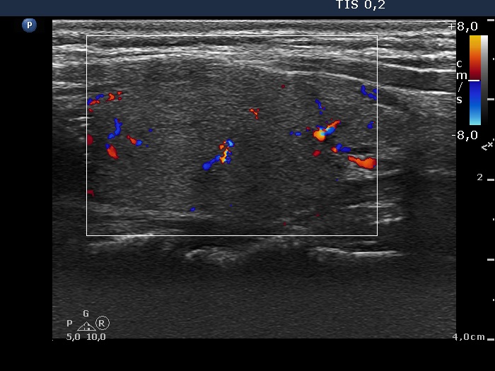 Right lobe, longitudinal scan