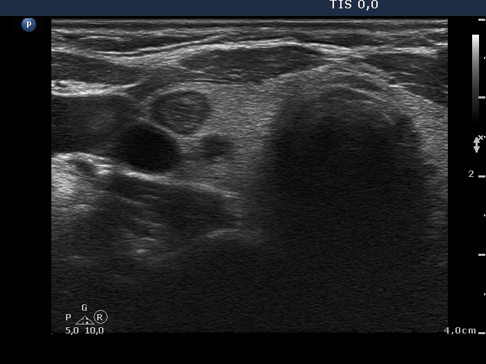 Right lobe, longitudinal scan