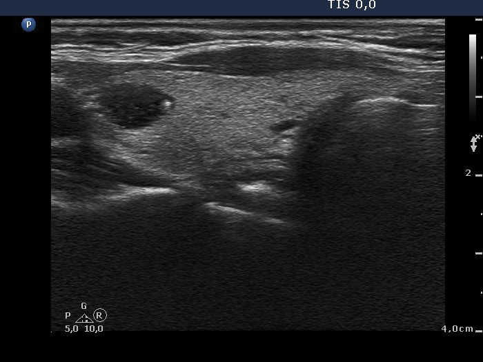 Right lobe, longitudinal scan