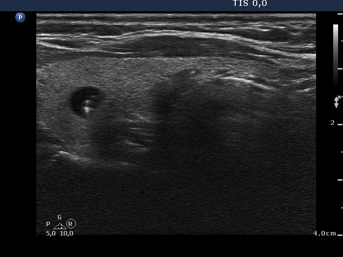 Right lobe, longitudinal scan