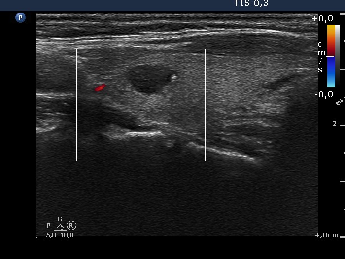 Right lobe, longitudinal scan