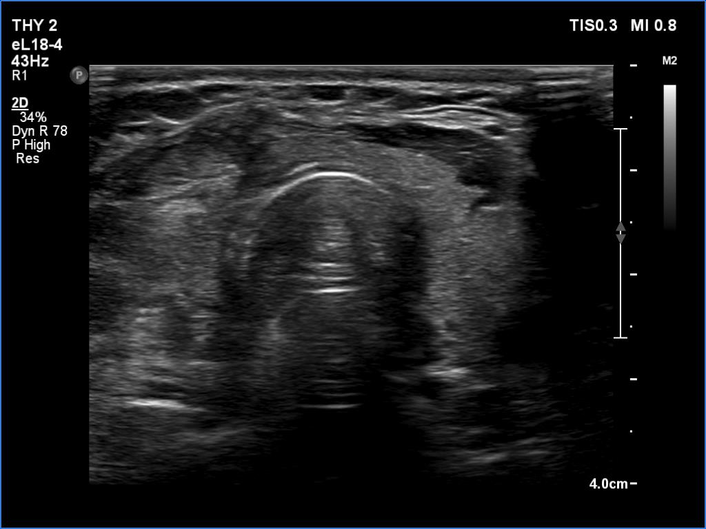Right lobe, longitudinal scan
