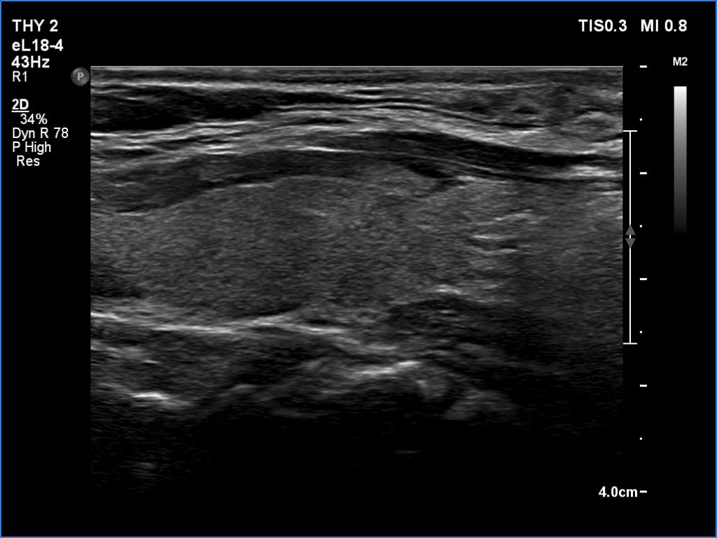 Right lobe, longitudinal scan