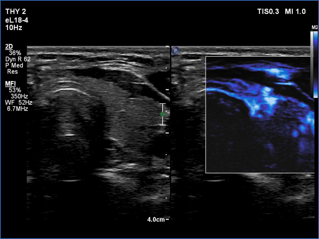 Right lobe, longitudinal scan