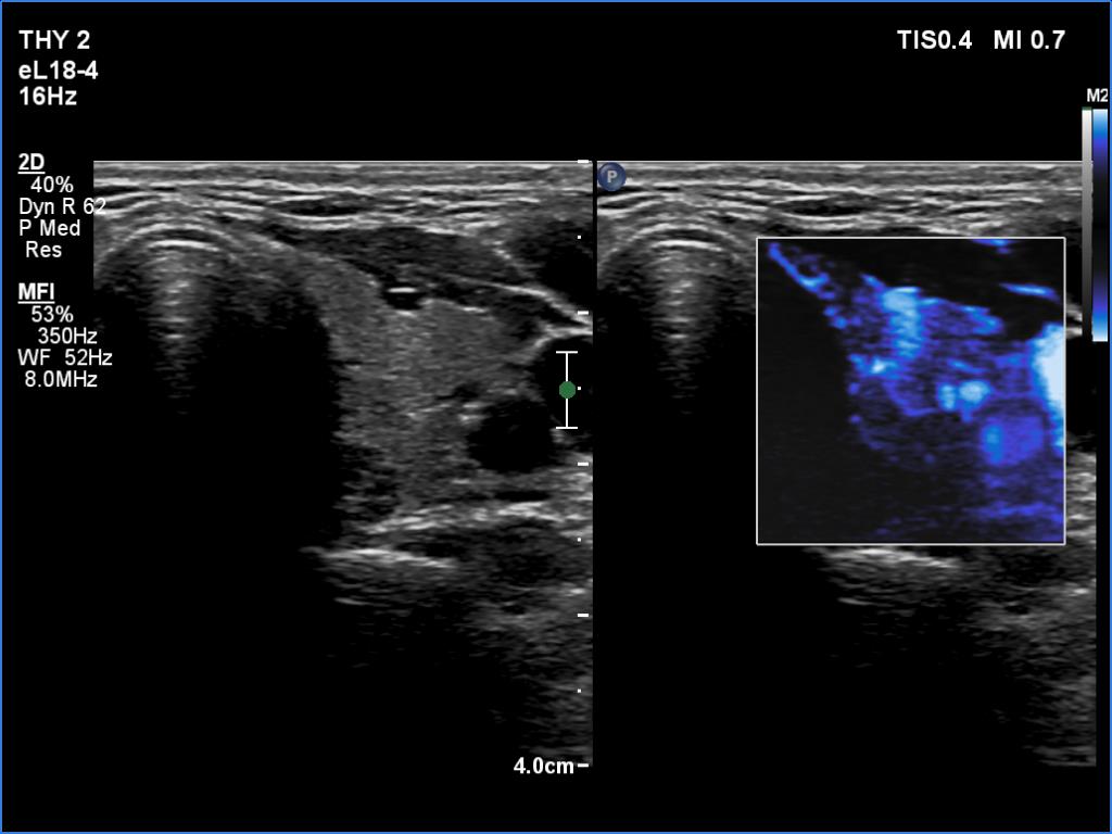 Right lobe, longitudinal scan