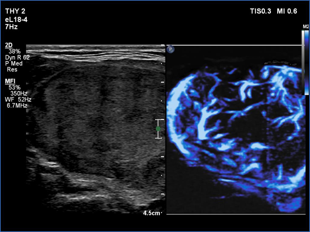 Right lobe, longitudinal scan