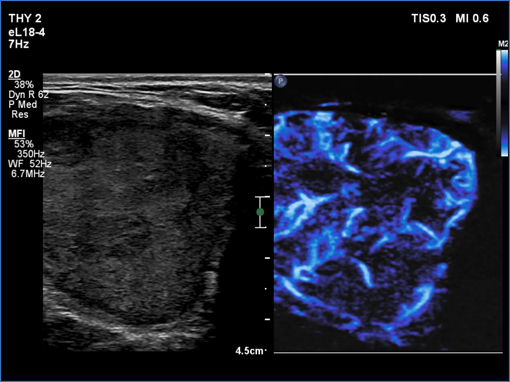 Right lobe, longitudinal scan