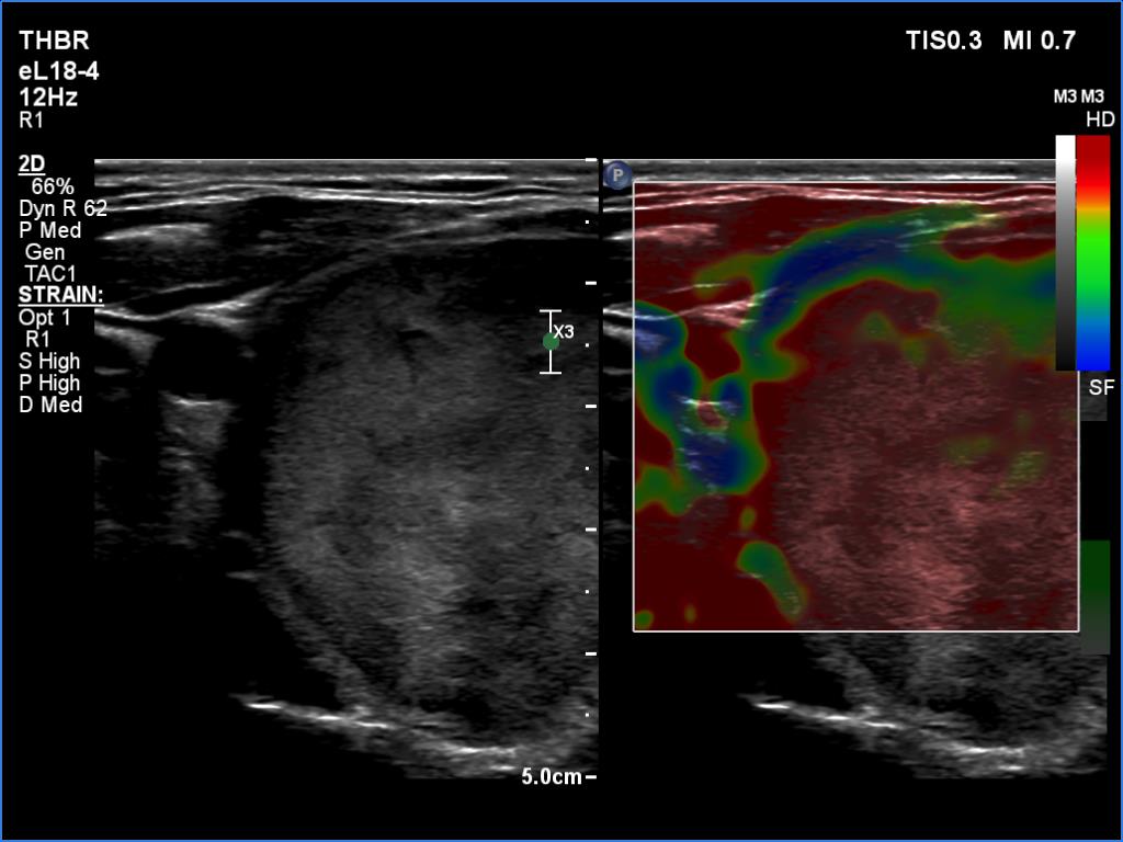 Right lobe, longitudinal scan