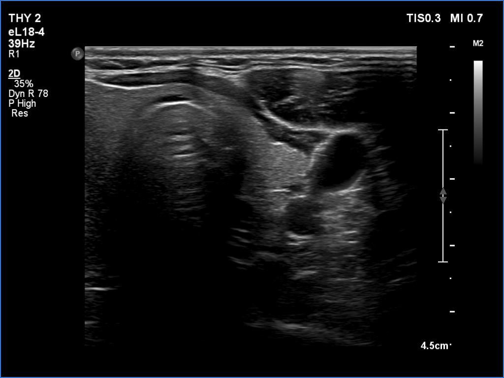 Right lobe, longitudinal scan