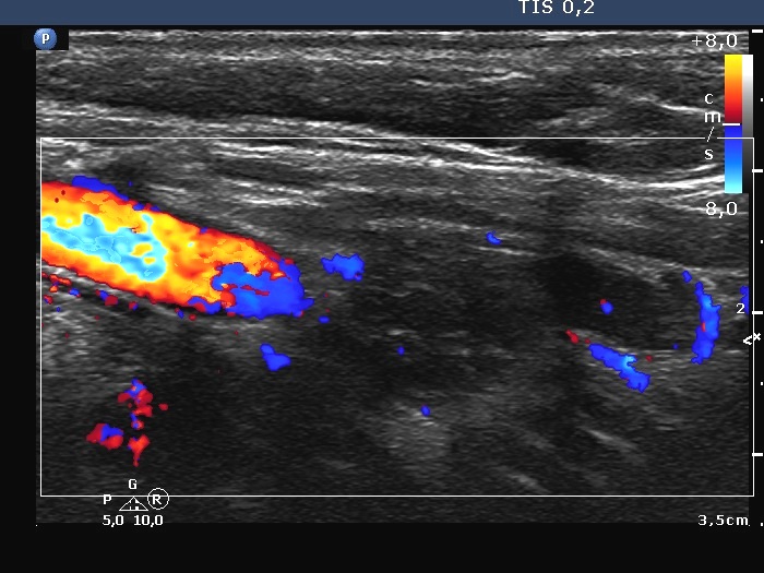 Right lobe, longitudinal scan