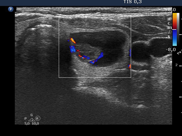 Right lobe, longitudinal scan