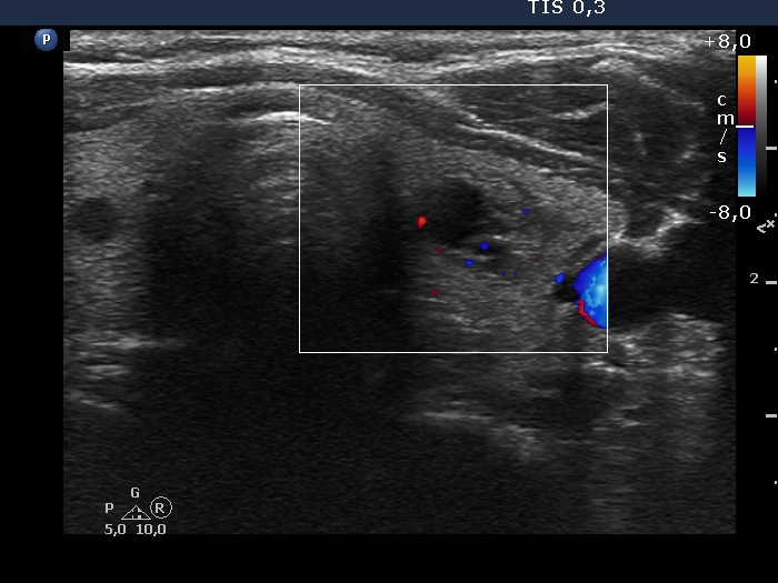 Right lobe, longitudinal scan