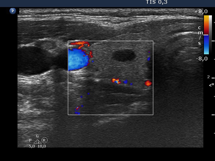Right lobe, longitudinal scan