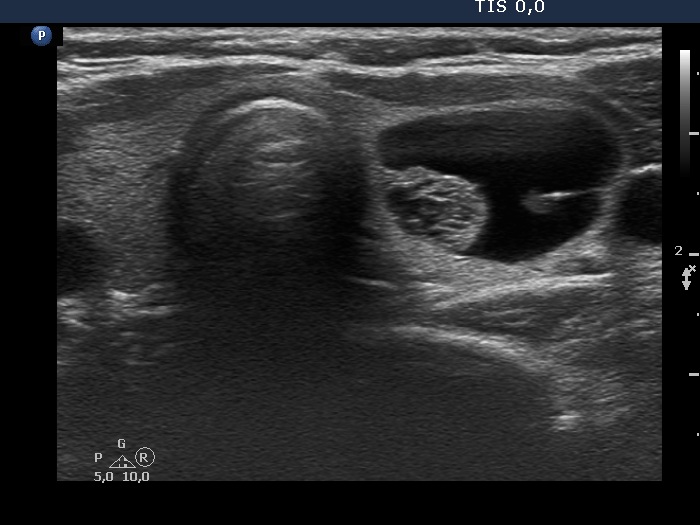 Right lobe, longitudinal scan