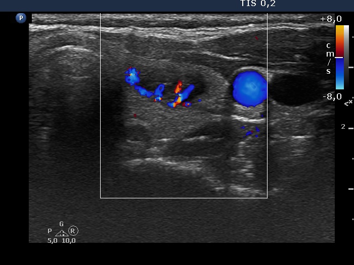 Right lobe, longitudinal scan