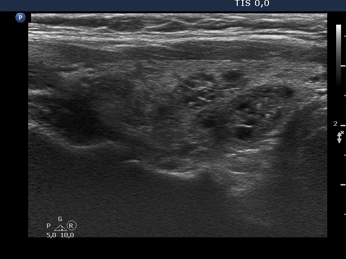 Right lobe, longitudinal scan