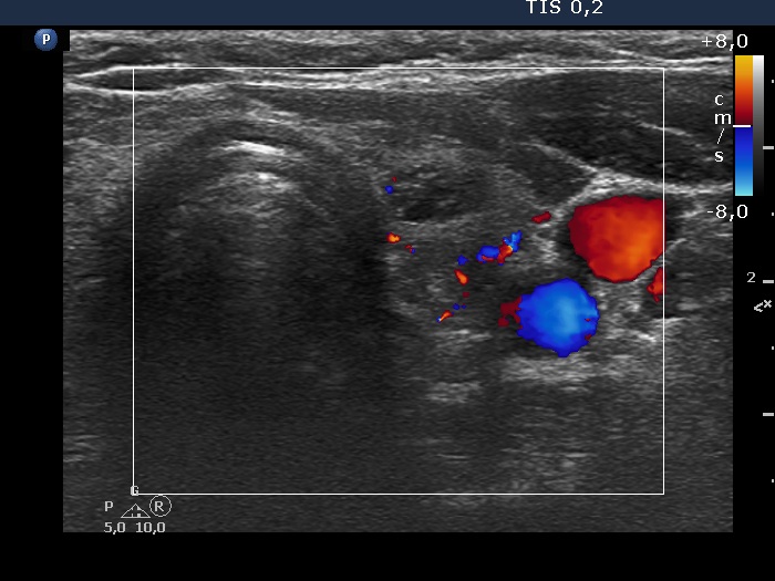 Right lobe, longitudinal scan