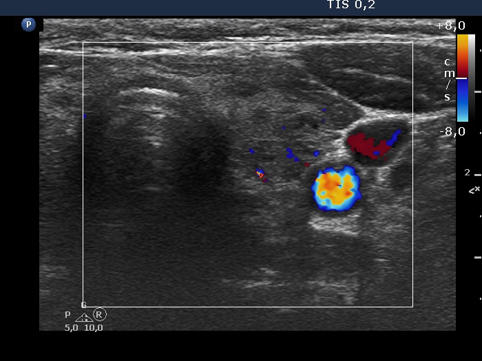 Right lobe, longitudinal scan