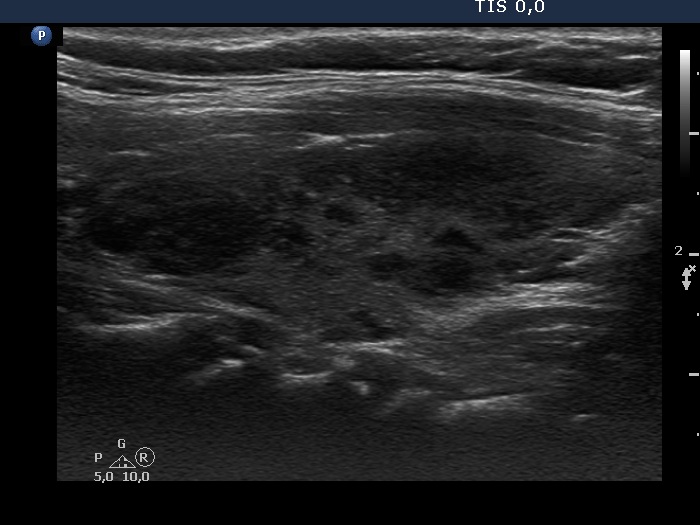Right lobe, longitudinal scan