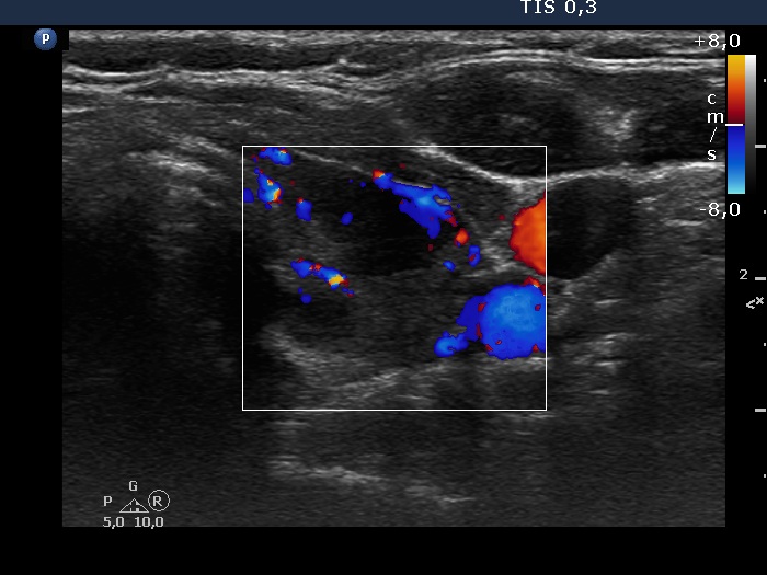 Right lobe, longitudinal scan