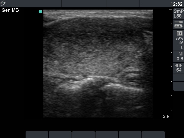 Right lobe, longitudinal scan