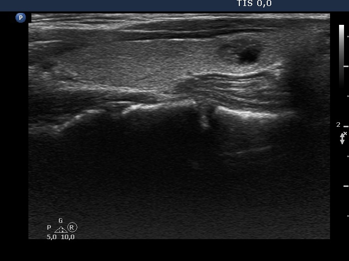 Right lobe, longitudinal scan