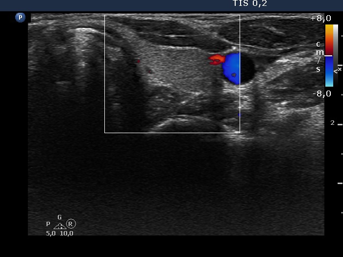 Right lobe, longitudinal scan