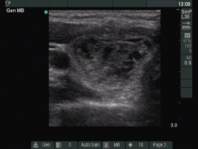 Right lobe, longitudinal scan