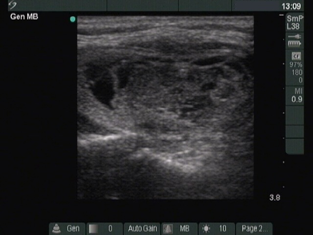 Right lobe, longitudinal scan