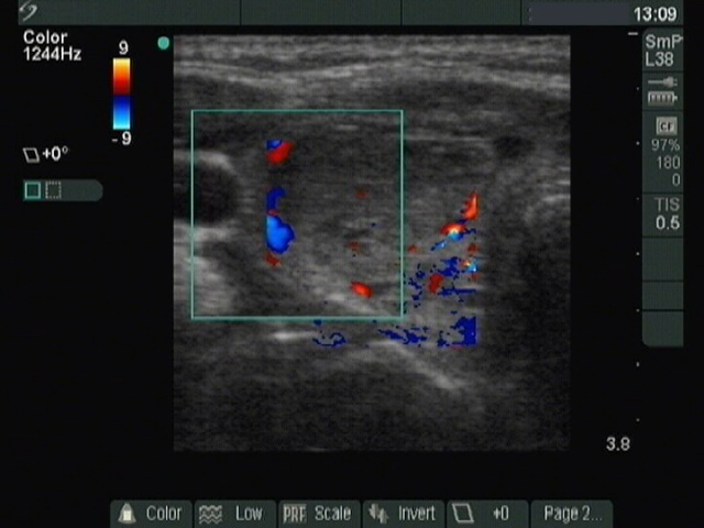 Right lobe, longitudinal scan