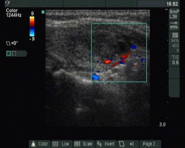 Right lobe, longitudinal scan