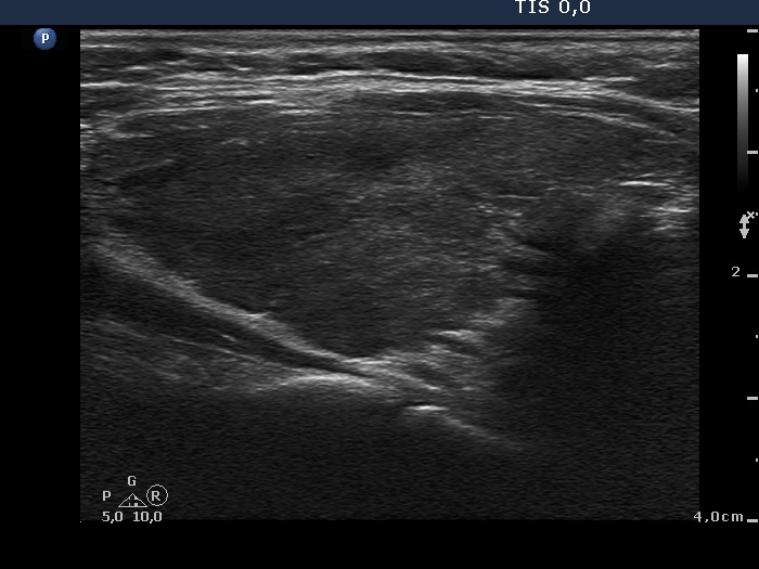 Right lobe, longitudinal scan