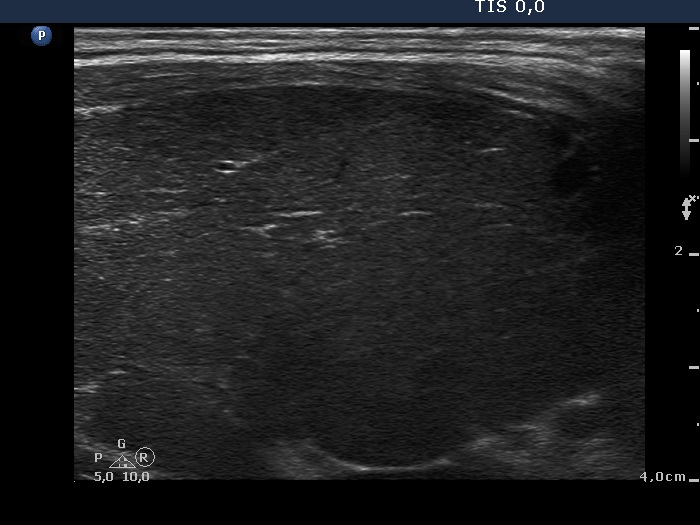 Right lobe, longitudinal scan