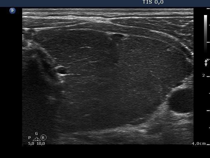 Right lobe, longitudinal scan